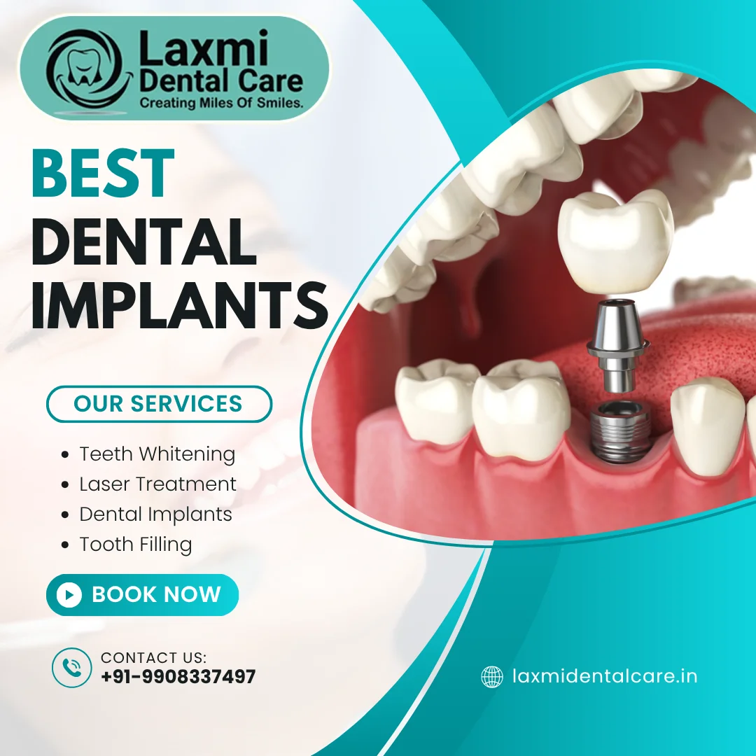 Read more about the article Dental Implants in Hyderabad